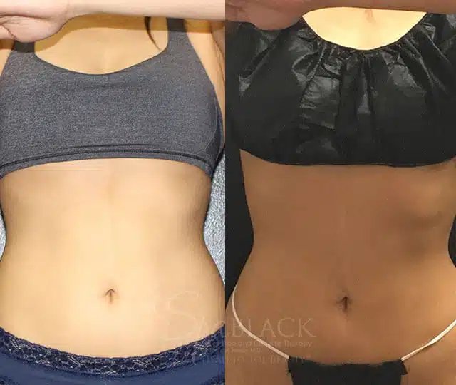 Abdomen before and after
