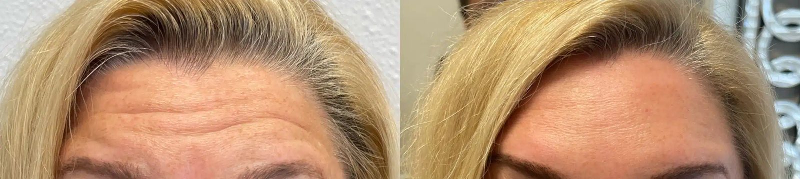 Botox before and after: crow’s feet around the eye, then softened