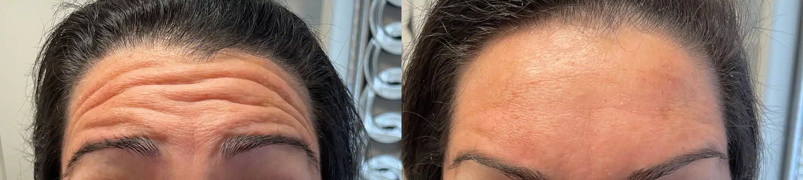 Botox before and after: forehead lines at rest, then visibly smoother