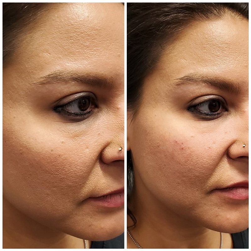 Face before and after, front view