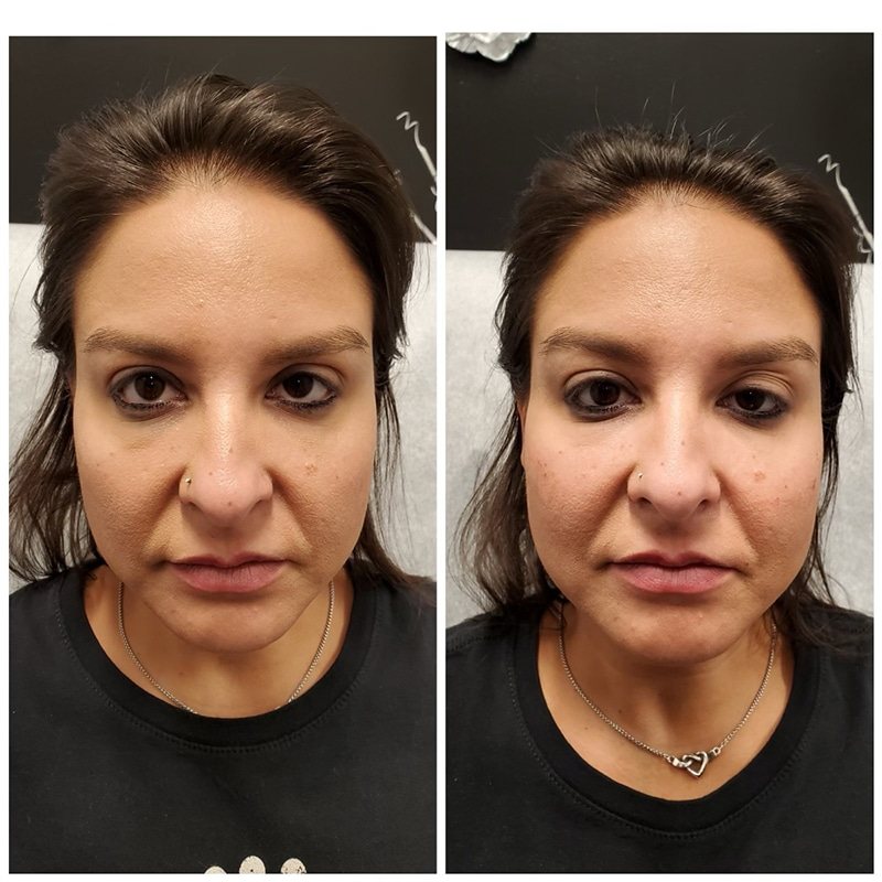 Face before and after, three-quarter view