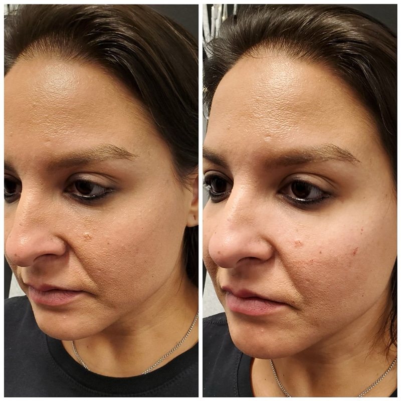 Face before and after, side view