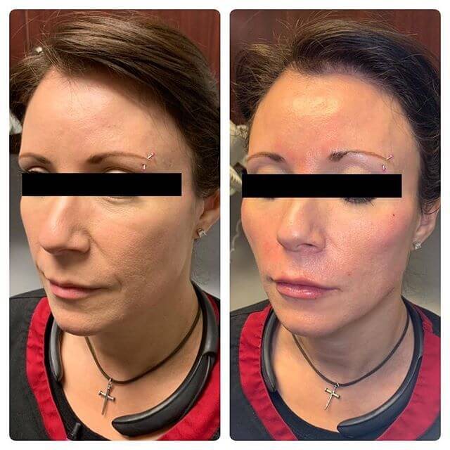 Injectable before and after, eyes obscured for privacy