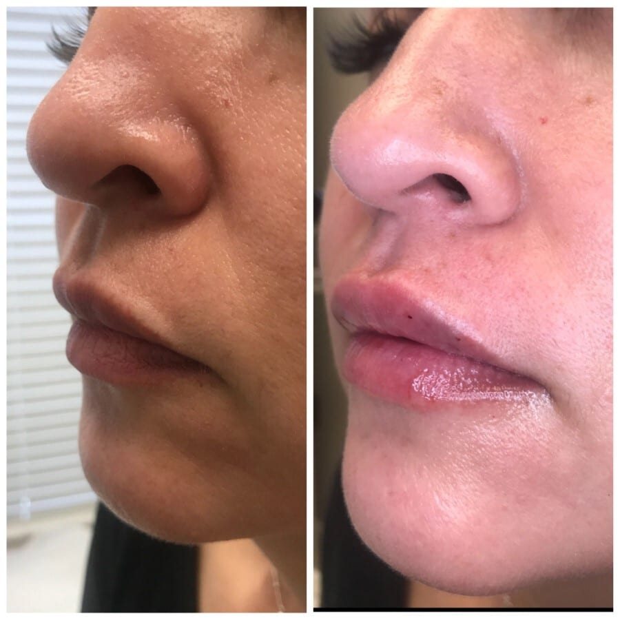 Lip filler before and after, profile