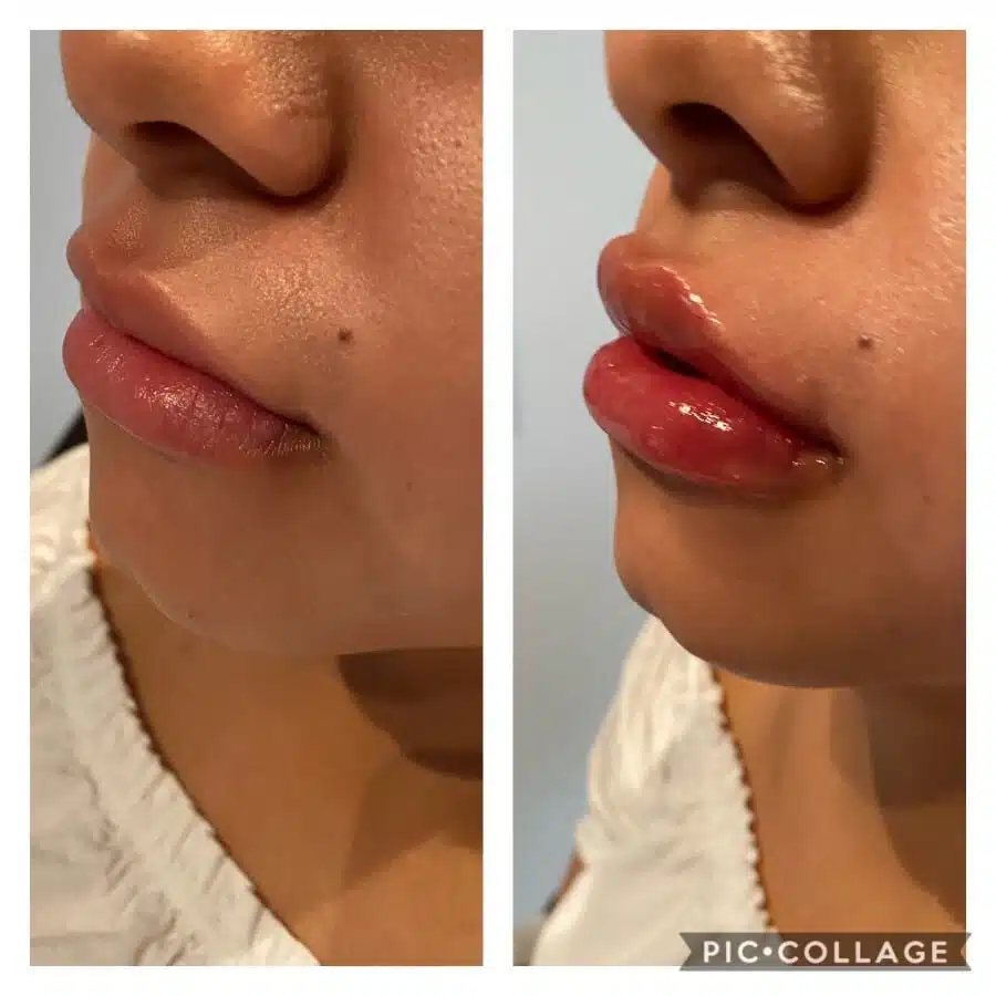 Lip filler before and after, profile