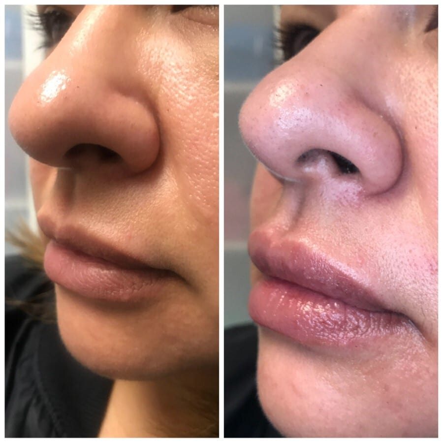 Lip filler before and after, profile
