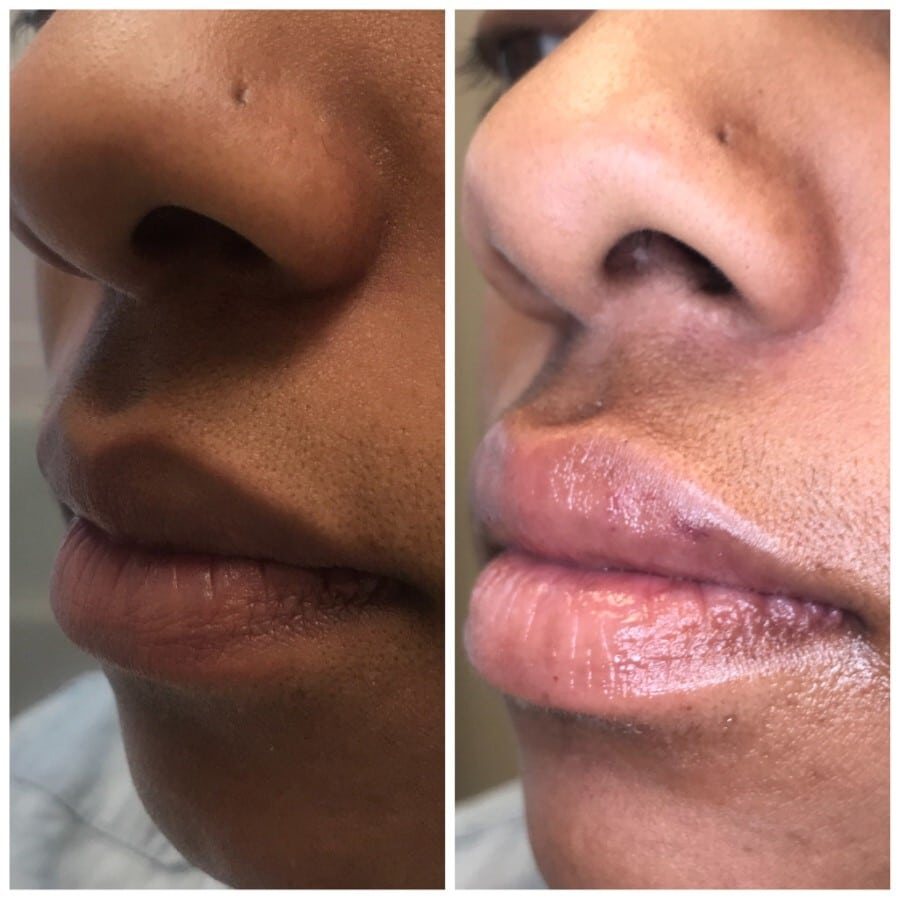 Lip filler before and after, profile