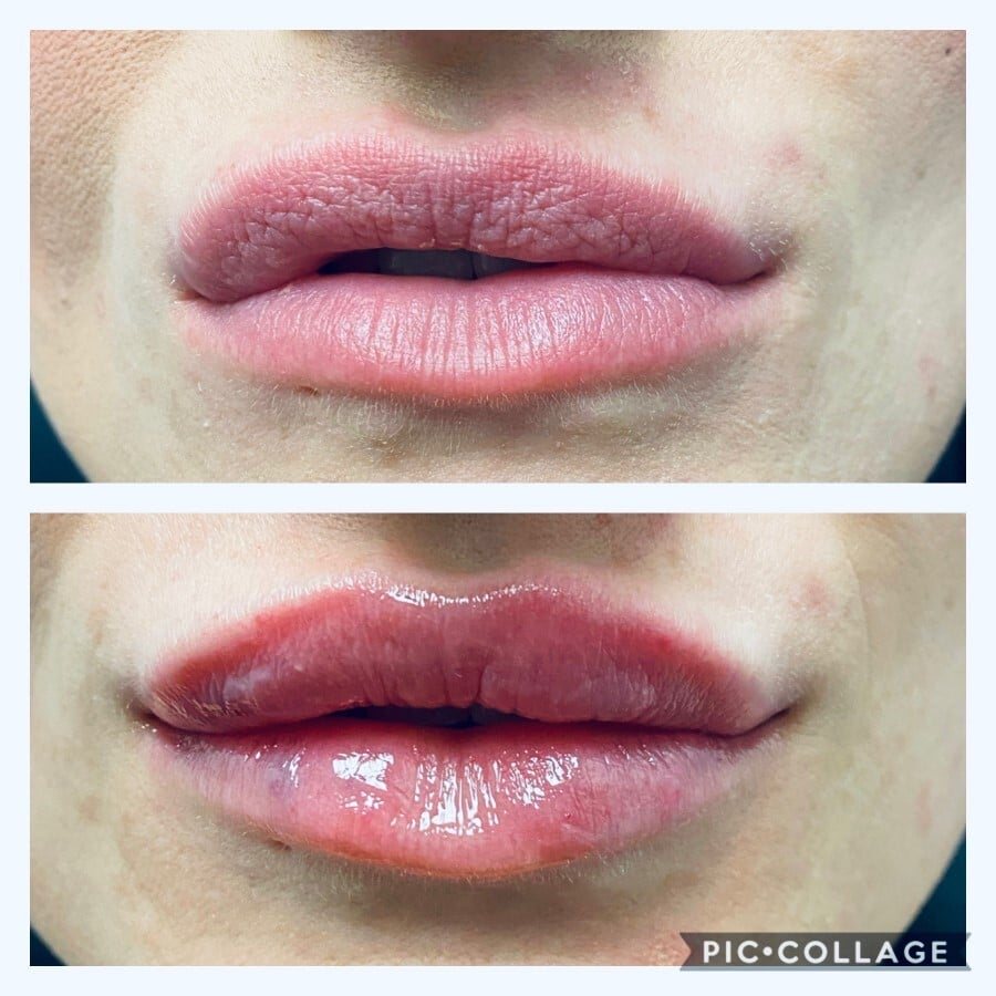Lip filler before and after, front