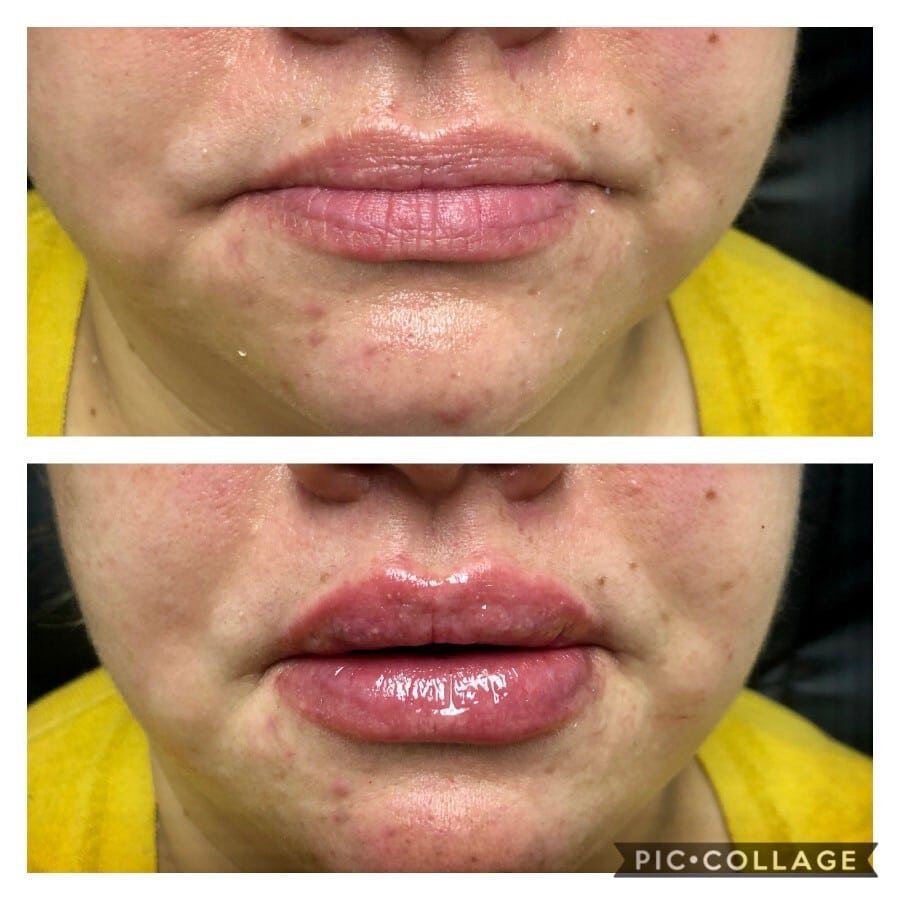 Lip filler before and after, front