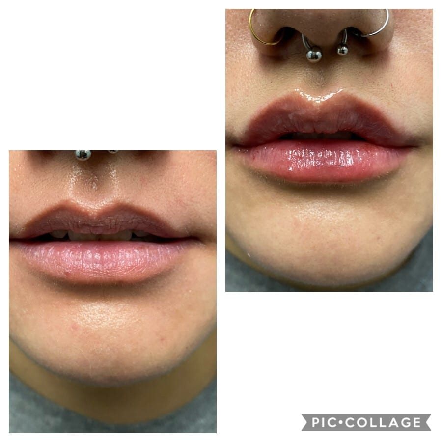 Lip filler before and after, front
