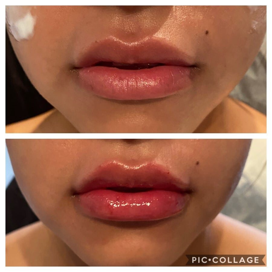 Lip filler before and after, front