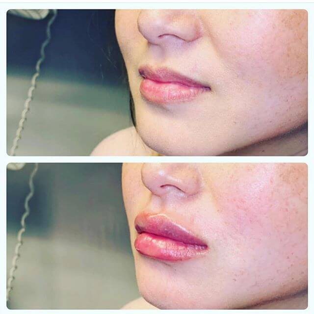 Lip filler before and after, close-up