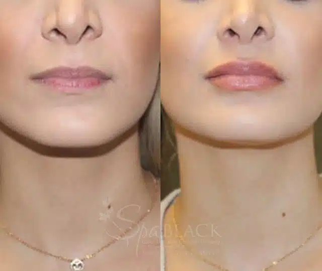 Jawline and neck before and after