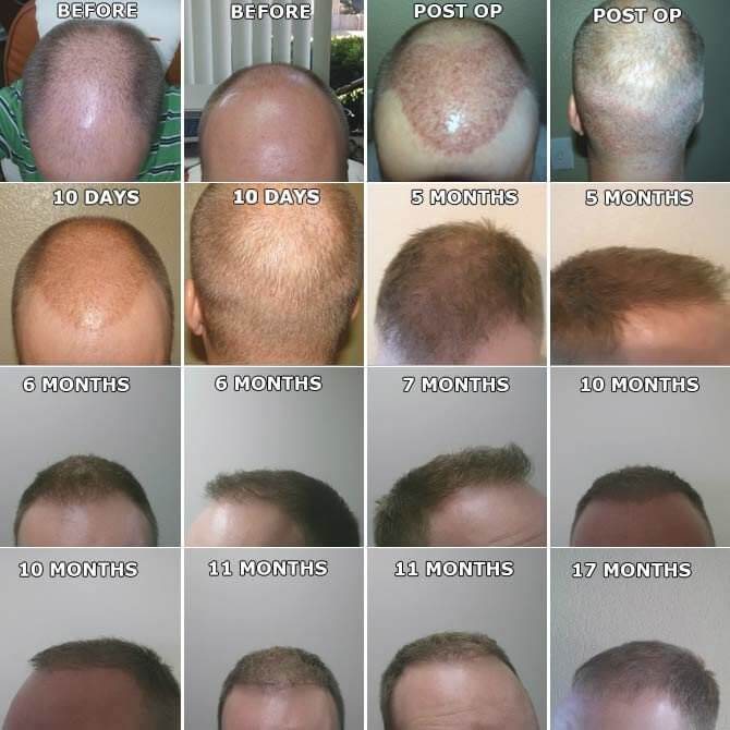 NeoGraft hair restoration progress from before to 17 months after