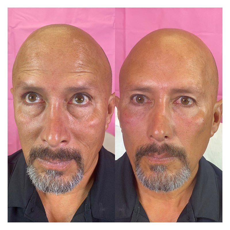 Restylane before and after on a man’s face