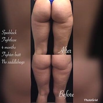 Fotona TightLase before and after on the back of the thighs, four months apart